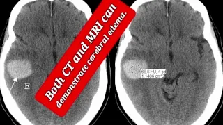 Cerebral edema in CT