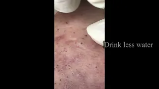 ACNE BLACKHEAD ON SKIN