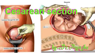 Cesarean section| cesarean delivery| procedure | techniques | Lscs vs classical cesarean