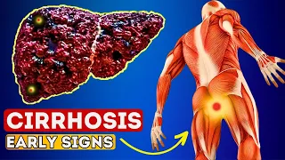 12 Early Signs of Liver CIRRHOSIS | LIVER is DYING!