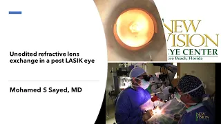 Unedited refractive lens exchange in a post LASIK eye