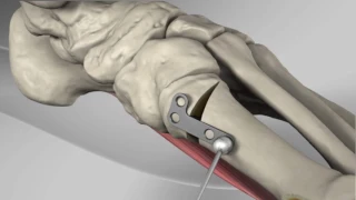 First Metatarsal Proximal Opening Wedge Osteotomy with Arthrex® LPS POW Plate