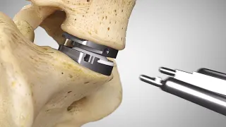 prodisc® L Surgical Technique Animation (2021) | Lumbar Total Disc Replacement | Disc Arthroplasty