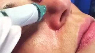 Чистка лица HydraFacial в Клинике Goravsky