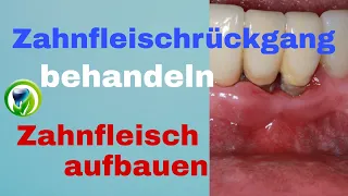 Zahnfleischtransplantation - freiliegende Zahnhälse - Zahnfleisch wieder aufbauen und decken