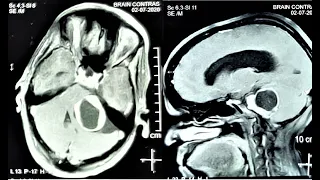 LARGE CYSTIC VESTIBULAR-ACCOUSTIC SCHWANNOMA-microsurgery-dr suresh dugani/HUBBALLI/KARNATAKA/INDIA