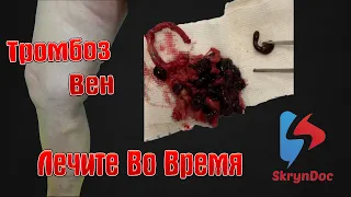 Женщина чуть не умерла от тромба. Флеболог Алексей Скринник, Киев, Украина.⚠️⚠️⚠️