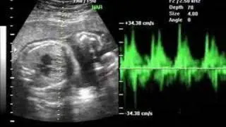 Our daughter's heartbeat