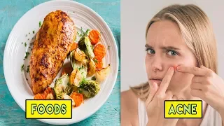 Is Your Acne Linked To Your Food Habits?