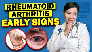 Early Warning Signs Of Rheumatoid Arthritis | Don't Ignore These Vital Symptoms!