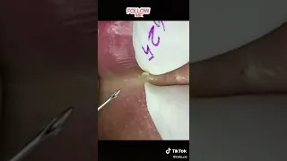 Blackheads removal around the mouth