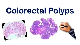 Colorectal Polyps| USMLE STEP, NCLEX, COMLEX