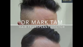 Receding Hairline, Before & After Hair Transplant by Dr  Mark Tam