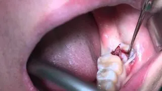 2 Min, AnyRidge implant surgery