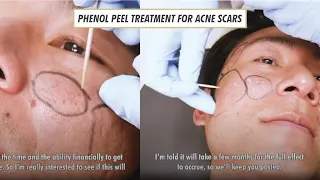 Phenol Peel Treatment for Acne Scars