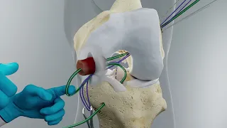 BEAR Implant Procedure | Step-by-Step Animation | Miach Orthopaedics