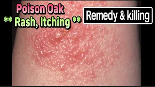 Poison Oak rash, itching, remedy and killing.