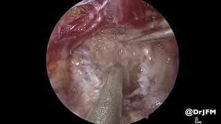 Endoscopic Endonasal Resection of a Tuberculum Sella Meningioma