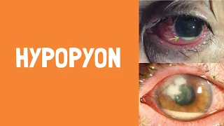 Causes of Hypopyon | Ocular signs