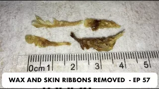 LONG SKIN RIBBONS AND EAR WAX REMOVAL  - EP 57