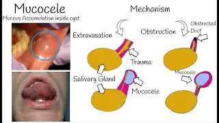 Oral Mucocele -  The Most Common Mucosal lesion - Mucous Cyst: Symptoms, Causes & Treatment