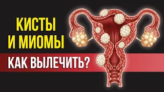 ЧТО СКРЫВАЕТ МЕДИЦИНА: почему образуются кисты и миомы и как их вылечить САМОСТОЯТЕЛЬНО?