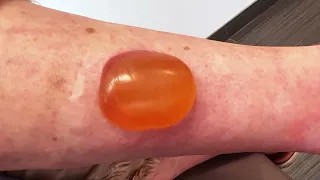 Mosquito Bite Filled With JELLY Gets Popped!