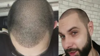 Результат пересадки волос и видео отзыв Никиты из России / Hair transplant before and after