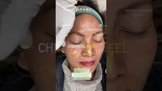 AISHH Chemical peel, customised for pigmentation and dullness| Delhi #aishh #pigmentationremedy