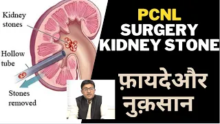 किडनी स्टोन के लिए पीसीएनएल ऑपरेशन I Unveiling Benefits and Risks of PCNL Surgery for Kidney Stones