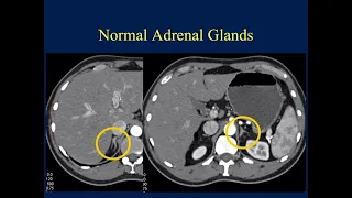 CT of the Adrenal Mass: A Challenging Diagnosis Becomes Even More Difficult - Part 1