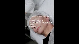 Коррекция возрастных изменений периорбитальной зоны с помощью Newlic Healer Strong