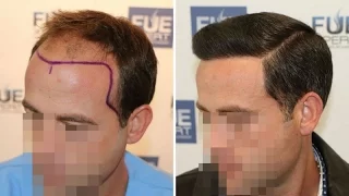 FUE Hair Transplant (3958 grafts in NW-Class lV-A), Dr. Juan Couto - FUEXPERT CLINIC - Madrid, Spain