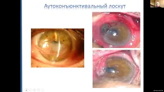 Хирургические методы лечения инфекционных кератитов