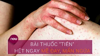 Bài thuốc "tiên" giúp hết liền mẩn ngứa | VTC Now