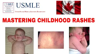 MASTERING CHILDHOOD RASHES MEASLES RUBELLA ROSEOLA SCARLET FEVER  #USMLE #MCC #CLINICAL MEDICINE