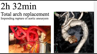 2h32min Total arch replacement  / 弓部大動脈人工血管置換術＋Open Stentgraft