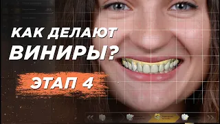 Виниры. Этап 4. 3D Моделирование улыбки (Wax-up). Виниры для зубов