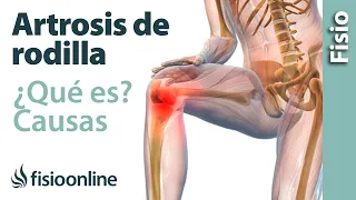 Osteoarthritis or knee wear - What is it, causes, symptoms and treatment