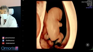 Pregnancy 10 weeks. 3D 4D images.