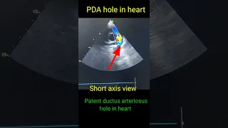 Patent ductus arteriosus ( PDA) hole in heart Echocardiography #youtubeshorts  #shorts