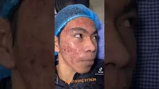 Acne peeling, start to be better