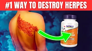 How to Destroy Herpes Fast and Naturally