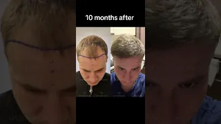 Hair Transplant  Before and after | Пересадка Волос Результат до и после #hairtransplantturkey