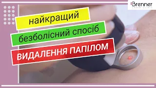 Удаление папиллом | Видалення папілом | Клініка лікаря Бреннера (Київ)