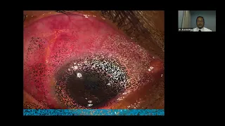 Lecture: Scleral and Corneal Inflammatory Disorders