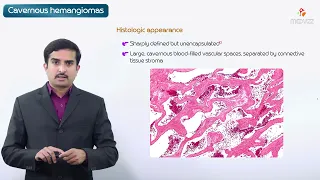 Cavernous hemangioma - Pathology Usmle step 1
