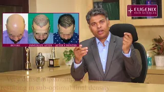 Maximum density that is possible after a hair transplant explained by expert hair transplant surgeon