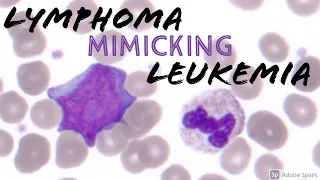 Circulating Diffuse Large B-cell Lymphoma Cell Mimicking Acute Myeloid Leukemia AML Blast Hematology