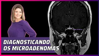 DIAGNOSTICANDO O MICROADENOMA: COMO INTERPRETAR A RESSONÂNCIA DE HIPÓFISE